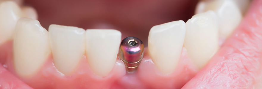 implant dentaire en Hongrie